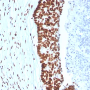 Formalin-fixed, paraffin-embedded human colon stained with MSH2 Mouse Monoclonal Antibody (MSH2/3165). HIER: Tris/EDTA, pH9.0, 45min. 2°C: HRP-polymer, 30min. DAB, 5min.