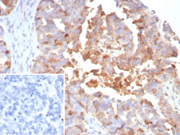IHC analysis of formalin-fixed, paraffin-embedded human ovarian cancer.  MX1 Mouse Monoclonal Antibody (MX1/7530).  Inset: PBS instead of primary antibody; secondary only negative control.