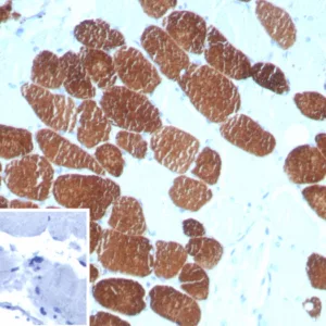 Formalin-fixed, paraffin-embedded human breast carcinoma stained with MYH7 Mouse Monoclonal Antibody (MYH7/727). Inset: PBS instead of primary antibody; secondary only negative control.