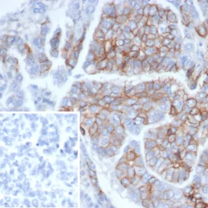 Formalin-fixed, paraffin-embedded human ovarian cancer stained with CD56 Mouse Monoclonal Antibody (NCAM/6715). Inset: PBS instead of primary antibody; secondary only negative control.