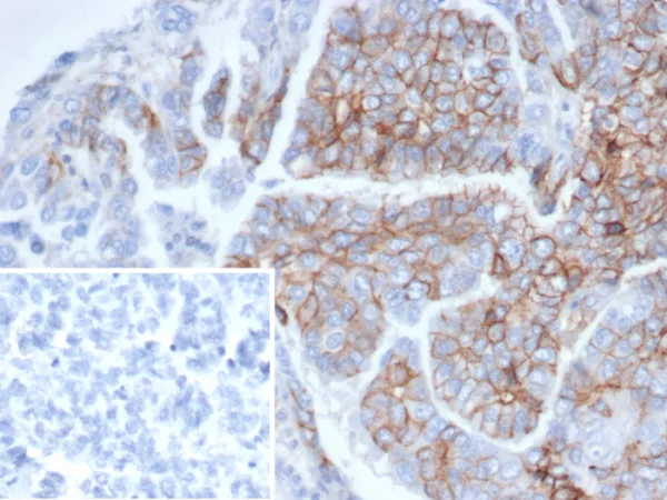 Formalin-fixed, paraffin-embedded human ovarian cancer stained with CD56 Mouse Monoclonal Antibody (NCAM1/6715). Inset: PBS instead of primary antibody; secondary only negative control.