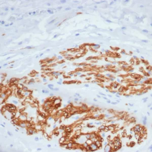 Formalin-fixed, paraffin-embedded human colon stained with CD56 Mouse Monoclonal Antibody (NCAM/7520). HIER: Tris/EDTA, pH9.0, 45min. 2°C: HRP-polymer, 30min. DAB, 5min.
