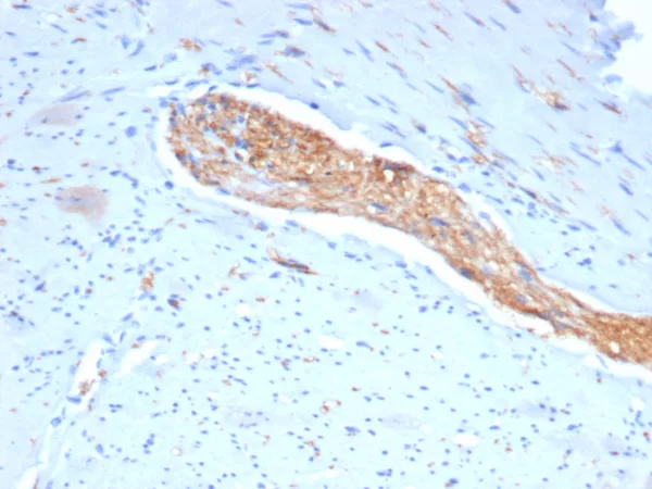 Formalin-fixed, paraffin-embedded human colon stained with CD56 Mouse Monoclonal Antibody (NCAM/7522). HIER: Tris/EDTA, pH9.0, 45min. 2°C: HRP-polymer, 30min. DAB, 5min.