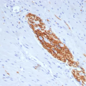 Formalin-fixed, paraffin-embedded human colon stained with CD56 Mouse Monoclonal Antibody (NCAM/7523). HIER: Tris/EDTA, pH9.0, 45min. 2°C: HRP-polymer, 30min. DAB, 5min.