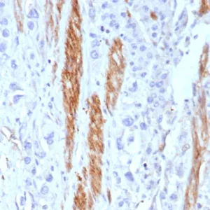 Formalin-fixed, paraffin-embedded human colon stained with CD56 Recombinant Mouse Monoclonal Antibody (rNCAM1/8580). HIER: Tris/EDTA, pH9.0, 45min. 2°C: HRP-polymer, 30min. DAB, 5min.