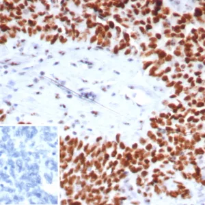Formalin-fixed, paraffin-embedded human ovarian cancer stained with Nucleolin Mouse Monoclonal Antibody (NCL/7743). HIER: Tris/EDTA, pH9.0, 45min. 2°C: HRP-polymer, 30min. DAB, 5min.
