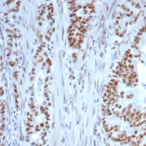 Formalin-fixed, paraffin-embedded human colon stained with Nucleolin Mouse Monoclonal Antibody (NCL/7339). HIER: Tris/EDTA, pH9.0, 45min. 2°C: HRP-polymer, 30min. DAB, 5min.