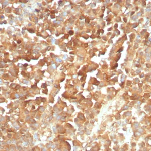 Formalin-fixed, paraffin-embedded human melanoma stained with NGFR Mouse Recombinant Monoclonal Antibody (rNGFR/8824). HIER: Tris/EDTA, pH9.0, 45min. 2°C: HRP-polymer, 30min. DAB, 5min.