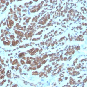 Formalin-fixed, paraffin-embedded human breast carcinoma stained with NME2 / nm23-H2 Mouse Monoclonal Antibody (NME2/6435). HIER: Tris/EDTA, pH9.0, 45min. 2°C: HRP-polymer, 30min. DAB, 5min.