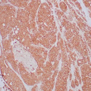 Formalin-fixed, paraffin-embedded human lung carcinoma stained with NTRK2 / TRKb Mouse Monoclonal Antibody (NTRK2/4673). HIER: Tris/EDTA, pH9.0, 45min. 2°C: HRP-polymer, 30min. DAB, 5min.