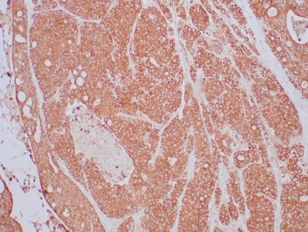 Formalin-fixed, paraffin-embedded human lung carcinoma stained with NTRK2 / TRKb Mouse Monoclonal Antibody (NTRK2/4673). HIER: Tris/EDTA, pH9.0, 45min. 2°C: HRP-polymer, 30min. DAB, 5min.