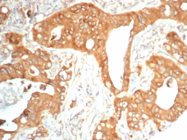Formalin-fixed, paraffin-embedded human colon carcinoma stained with NTRK2 / TRKb Mouse Monoclonal Antibody (NTRK2/4673). HIER: Tris/EDTA, pH9.0, 45min. 2°C: HRP-polymer, 30min. DAB, 5min.