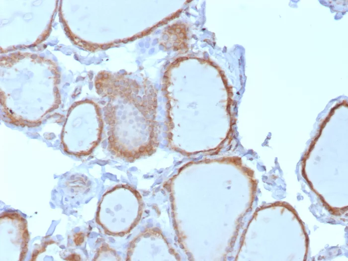 Formalin-fixed, paraffin-embedded human thyroid stained with NTRK2 / TRKb Mouse Monoclonal Antibody (NTRK2/7928). HIER: Tris/EDTA, pH9.0, 45min. 2°C: HRP-polymer, 30min. DAB, 5min. NTRK2 (Neurotrophic Receptor Tyrosine Kinase 2) Antibody - Image 2