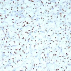 Formalin-fixed, paraffin-embedded human renal cell carcinoma stained with PAX2 Recombinant Rabbit Monoclonal Antibody (PAX2/8671R) at 2ug/ml. HIER: Tris/EDTA, pH9.0, 45min. 2°C: HRP-polymer, 30min. DAB, 5min.