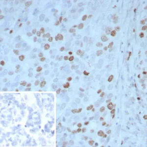 Formalin-fixed, paraffin-embedded human ovarian carcinoma stained with PAX4 Mouse Monoclonal Antibody (PAX4/7598). Inset: PBS instead of primary antibody; secondary only negative control.