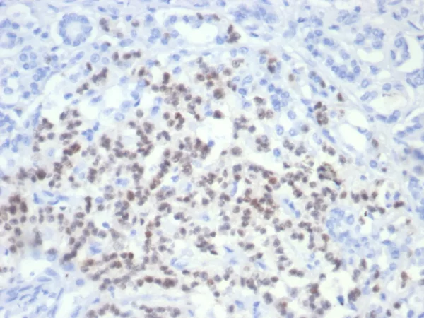 Formalin-fixed, paraffin-embedded human pancreatic cancer stained with PAX6 Mouse Monoclonal Antibody (PAX6/7705). HIER: Tris/EDTA, pH9.0, 45min. 2°C: HRP-polymer, 30min. DAB, 5min.