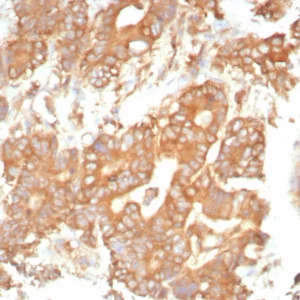 Formalin-fixed, paraffin-embedded human prostate stained with Alpha-1-Antitrypsin Mouse Monoclonal Antibody (AAT/4613). HIER: Tris/EDTA, pH9.0, 45min. 2°C: HRP-polymer, 30min. DAB, 5min.