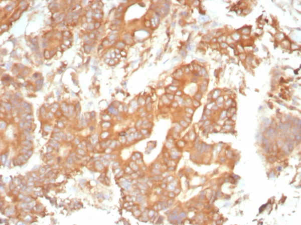 Formalin-fixed, paraffin-embedded human prostate stained with Alpha-1-Antitrypsin Mouse Monoclonal Antibody (AAT/4613). HIER: Tris/EDTA, pH9.0, 45min. 2°C: HRP-polymer, 30min. DAB, 5min.