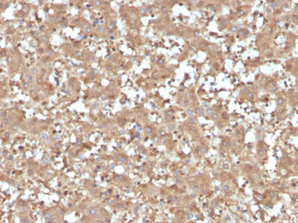 Formalin-fixed, paraffin-embedded human liver stained with Alpha-1-Antitrypsin Mouse Monoclonal Antibody (AAT/4615). HIER: Tris/EDTA, pH9.0, 45min. 2°C: HRP-polymer, 30min. DAB, 5min.