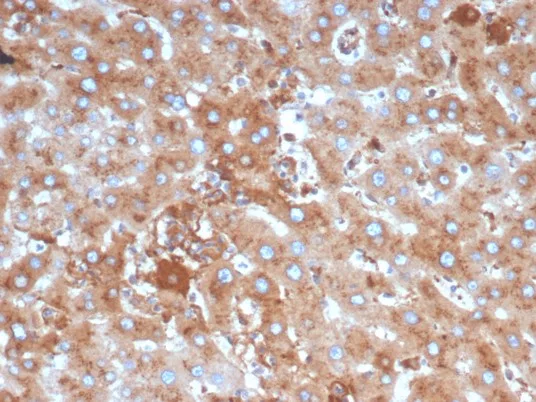 Formalin-fixed, paraffin-embedded human liver in colon stained with Alpha-1-Antitrypsin Mouse Monoclonal (AAT/6325). HIER: Tris/EDTA, pH9.0, 45min. 2°C: HRP-polymer, 30min. DAB, 5min. Alpha-1-Antitrypsin (SERPINA1) (Hepatocellular & Histiocytic Marker) Antibody - Image 3