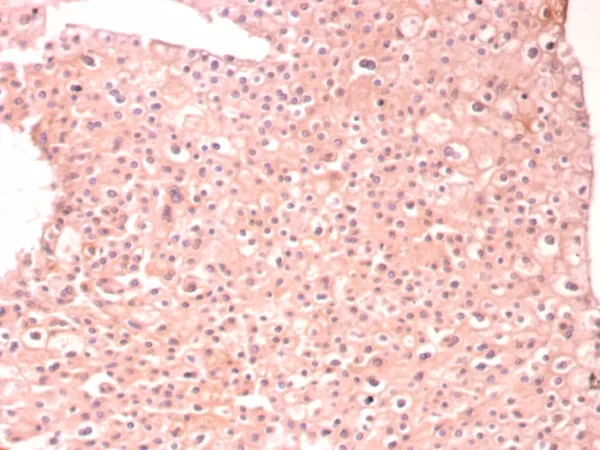 Formalin-fixed, paraffin-embedded human renal cell carcinoma stained with Alpha-1-Antitrypsin Mouse Monoclonal (AAT/8909). HIER: Tris/EDTA, pH9.0, 45min. 2°C: HRP-polymer, 30min. DAB, 5min.