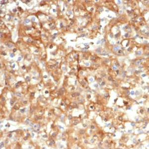 Formalin-fixed, paraffin-embedded human kidney carcinoma stained with Alpha-1-Antitrypsin Mouse Monoclonal Antibody (AAT/4609). HIER: Tris/EDTA, pH9.0, 45min. 2°C: HRP-polymer, 30min. DAB, 5min.