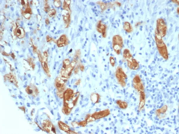 Formalin-fixed, paraffin-embedded human lung stained with Maspin Mouse Monoclonal Antibody (SERPINB5/4971). HIER: Tris/EDTA, pH9.0, 45min. 2°C: HRP-polymer, 30min. DAB, 5min.