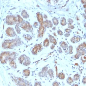 Formalin-fixed, paraffin-embedded human breast carcinoma stained with PTEN Mouse Monoclonal Antibody (PTEN/2159). HIER: Tris/EDTA, pH9.0, 45min. 2°C: HRP-polymer, 30min. DAB, 5min.