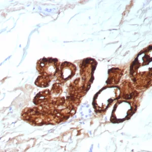 Formalin-fixed, paraffin-embedded human breast carcinoma stained with GCDFP-15 Recombinant Rabbit Monoclonal Antibody (PIP/9076R). HIER: Tris/EDTA, pH9.0, 45min. 2°C: HRP-polymer, 30min. DAB, 5min.