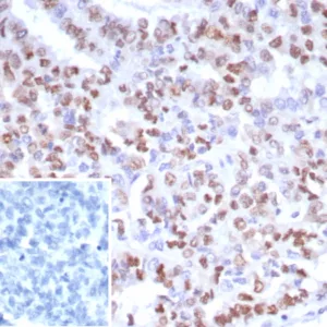 Formalin-fixed, paraffin-embedded human ovarian cancer stained with PMS2 Recombinant Rabbit Monoclonal Antibody (PMS2/8224R). Inset: PBS instead of primary antibody; secondary only negative control.