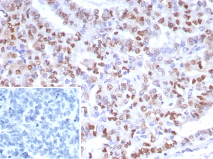 Formalin-fixed, paraffin-embedded human ovarian cancer stained with PMS2 Recombinant Rabbit Monoclonal Antibody (PMS2/8224R). Inset: PBS instead of primary antibody; secondary only negative control. Recombinant PMS2 (Postmeiotic Segregation Increased 2) Antibody