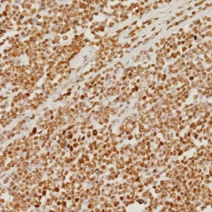 Formalin-fixed, paraffin-embedded human colon carcinoma stained with PMS2 Recombinant Rabbit Monoclonal Antibody (PMS2/8374R). HIER: Tris/EDTA, pH9.0, 45min. 2: HRP-polymer, 30min. DAB, 5min.