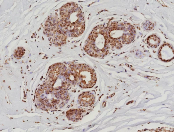 Formalin-fixed, paraffin-embedded human breast cancer stained with RNA Poll II Recombinant Rabbit Monoclonal Antibody (POLR2A/9089R). HIER: Tris/EDTA, pH9.0, 45min. 2°C: HRP-polymer, 30min. DAB, 5min.