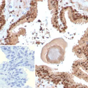 Formalin-fixed, paraffin-embedded human prostate stained with SOX18 Mouse Monoclonal Antibody (SOX18/3271). Inset: PBS instead of primary antibody; secondary only negative control.