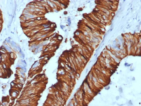 Formalin-fixed, paraffin-embedded human colon carcinoma stained with Cytokeratin 20 Recombinant Rabbit Monoclonal Antibody (KRT20/7805R). HIER: Tris/EDTA, pH9.0, 45min. 2: HRP-polymer, 30min. DAB, 5min.