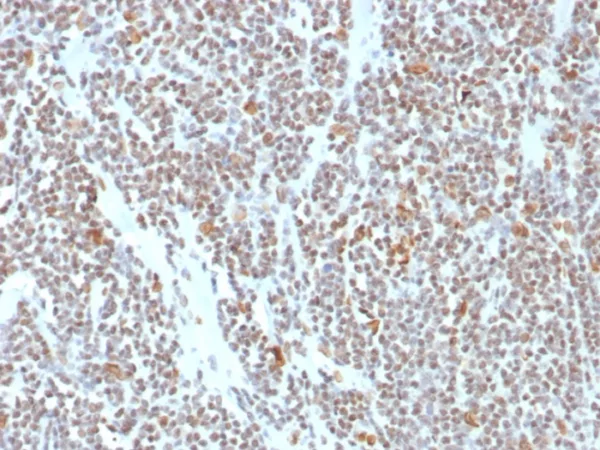 Formalin-fixed, paraffin-embedded human colon stained with ATRX Mouse Monoclonal Antibody (ATRX/7940). HIER: Tris/EDTA, pH9.0, 45min. 2°C: HRP-polymer, 30min. DAB, 5min.