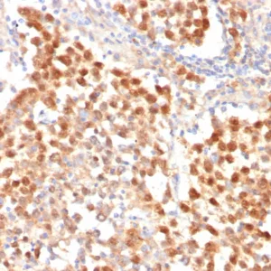 Formalin-fixed, paraffin-embedded human seminoma stained with OCT4 Recombinant Rabbit Monoclonal Antibody (OCT4/7347R) at 2ug/ml. HIER: Tris/EDTA, pH9.0, 45min. 2°C: HRP-polymer, 30min. DAB, 5min.