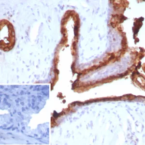 Formalin-fixed, paraffin-embedded human prostate carcinoma stained with PSAP Mouse Recombinant Monoclonal Antibody (ACPP/2472). HIER: Tris/EDTA, pH9.0, 45min. 2°C: HRP-polymer, 30min. DAB, 5min.