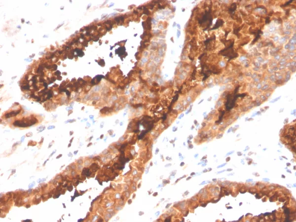Formalin-fixed, paraffin-embedded human prostate carcinoma stained with PSAP Recombinant Rabbit Monoclonal Antibody (ACPP/4495R).