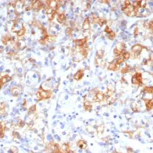 Formalin-fixed, paraffin-embedded human renal cell carcinoma stained with COX-2 Mouse Monoclonal Antibody (rCOX2/6996). HIER: Tris/EDTA, pH9.0, 45min. 2: HRP-polymer, 30min. DAB, 5min.