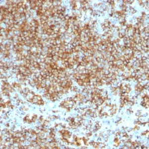 Formalin-fixed, paraffin-embedded human Lymphoma stained with CD45 Monoclonal Antibody (SPM569+SPM570).