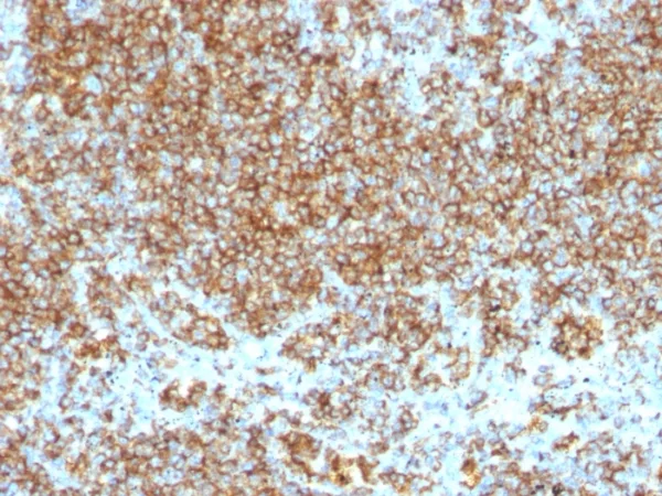 Formalin-fixed, paraffin-embedded human Lymphoma stained with CD45 Monoclonal Antibody (SPM569+SPM570).