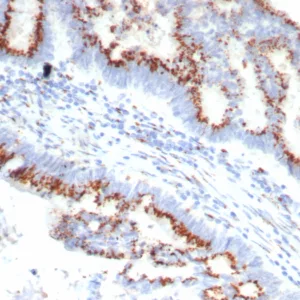 Formalin-fixed, paraffin-embedded human colon carcinoma stained with OVOL2 Mouse Monoclonal Antibody (OVOL2/6776). HIER: Tris/EDTA, pH9.0, 45min. 2°C: HRP-polymer, 30min. DAB, 5min.