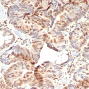 Formalin-fixed, paraffin-embedded human colon carcinoma stained with Retinoblastoma (Rb1) Monoclonal Antibody (rRB1/8060). HIER: Tris/EDTA, pH9.0, 45min. 2°C: HRP-polymer, 30min. DAB, 5min.