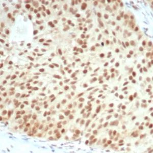 Formalin-fixed, paraffin-embedded human bladder carcinoma stained with Retinoblastoma Recombinant Rabbit Monoclonal Antibody (RB1/7080R). HIER: Tris/EDTA, pH9.0, 45min. 2°C: HRP-polymer, 30min. DAB, 5min.