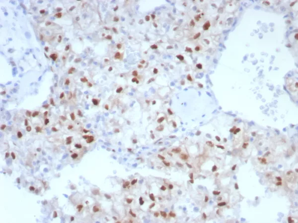 Formalin-fixed, paraffin-embedded human renal cell carcinoma stained Cyclin D1 Mouse Monoclonal Antibody (CCND1/7868). HIER: Tris/EDTA, pH9.0, 45min. 2°C: HRP-polymer, 30min. DAB, 5min.