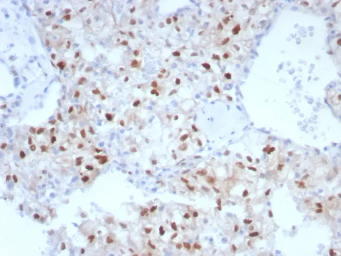 Formalin-fixed, paraffin-embedded human renal cell carcinoma stained Cyclin D1 Mouse Monoclonal Antibody (CCND1/7868). HIER: Tris/EDTA, pH9.0, 45min. 2°C: HRP-polymer, 30min. DAB, 5min. Cyclin D1 (G1-Cyclin & Mantle Cell Lymphoma Marker) Antibody
