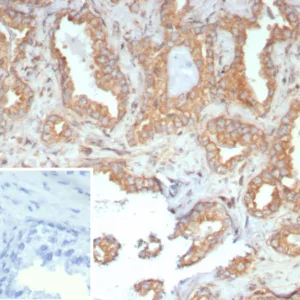 Formalin-fixed, paraffin-embedded human prostate carcinoma stained with RET Proto-oncogene Mouse Monoclonal Antibody (RET/7690). Inset: PBS instead of primary antibody; secondary only negative control.