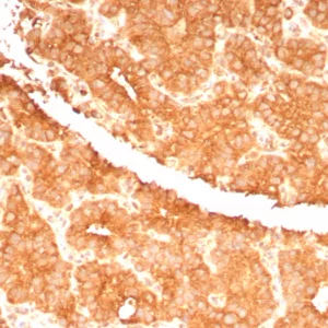 Formalin-fixed, paraffin-embedded human parathyroid gland stained with RET Proto-oncogene Mouse Monoclonal Antibody (RET/7694). HIER: Tris/EDTA, pH9.0, 45min. 2°C: HRP-polymer, 30min. DAB, 5min.