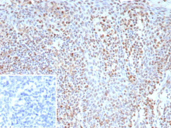 Formalin-fixed, paraffin-embedded human tonsil stained with BCL-6 Rabbit Recombinant Monoclonal Antibody (BCL6/9222R). Inset: PBS instead of primary antibody; secondary only negative control.